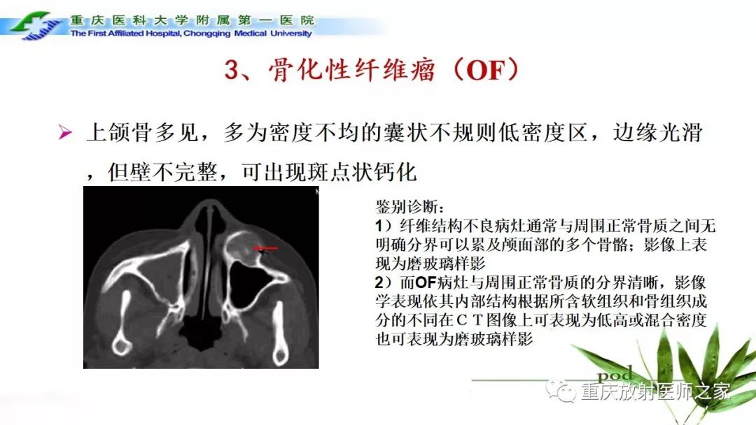 【PPT】颌骨常见肿瘤及肿瘤样病变的CT诊断及鉴别诊断-47