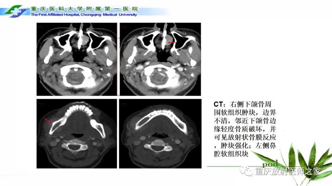 【PPT】颌骨常见肿瘤及肿瘤样病变的CT诊断及鉴别诊断-59