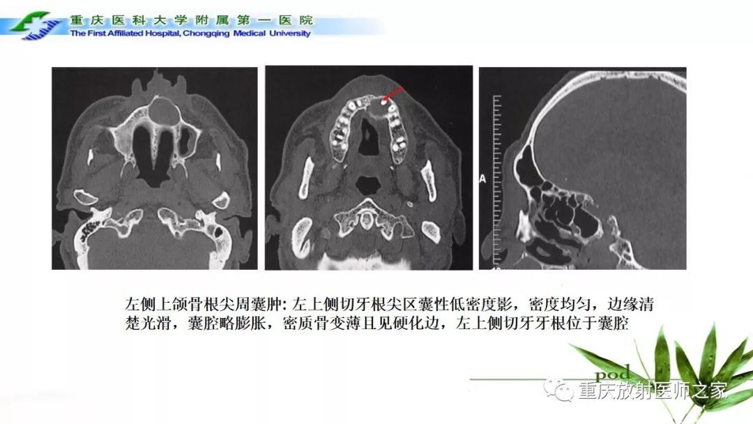 【PPT】颌骨常见肿瘤及肿瘤样病变的CT诊断及鉴别诊断-7