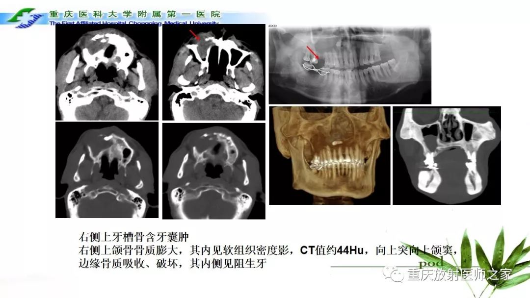 【PPT】颌骨常见肿瘤及肿瘤样病变的CT诊断及鉴别诊断-11