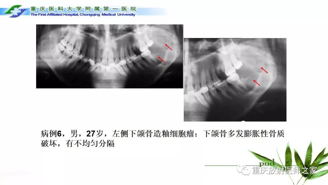 【PPT】颌骨常见肿瘤及肿瘤样病变的CT诊断及鉴别诊断-34