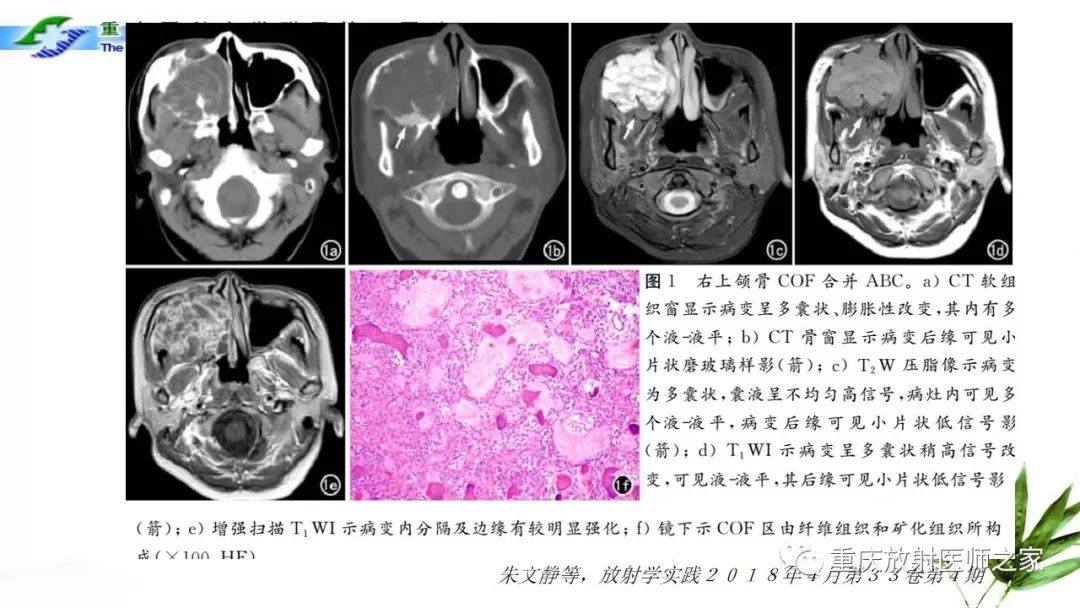 【PPT】颌骨常见肿瘤及肿瘤样病变的CT诊断及鉴别诊断-41