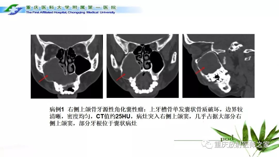 【PPT】颌骨常见肿瘤及肿瘤样病变的CT诊断及鉴别诊断-15