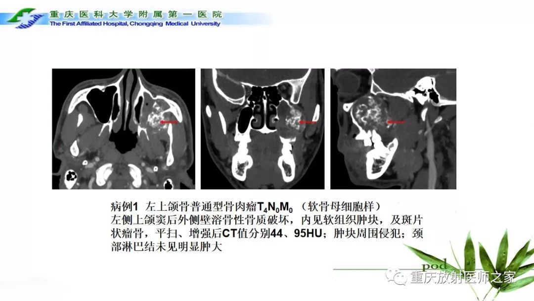 【PPT】颌骨常见肿瘤及肿瘤样病变的CT诊断及鉴别诊断-51