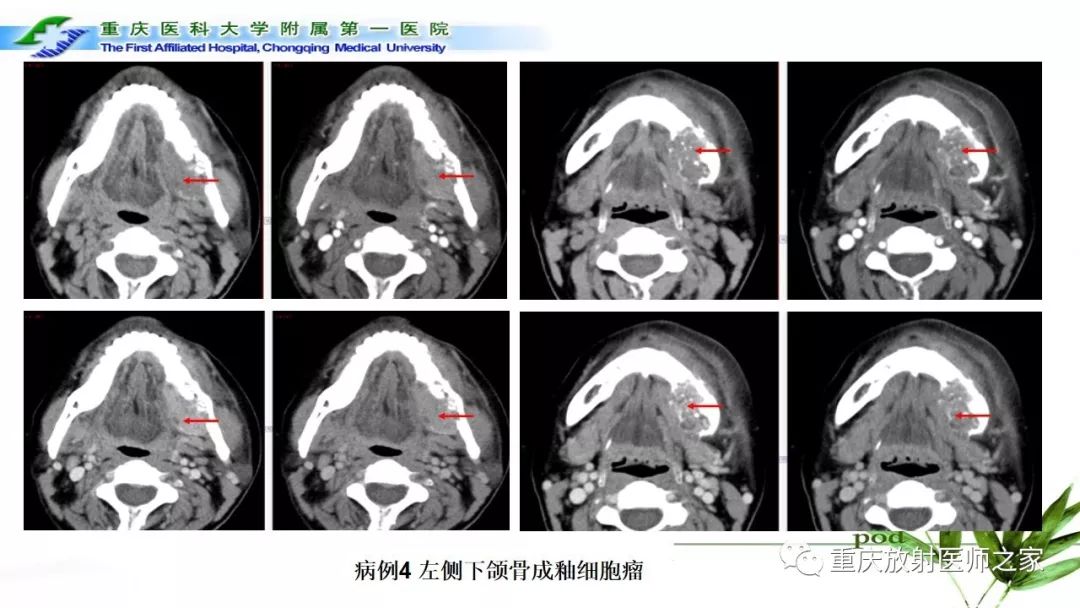 【PPT】颌骨常见肿瘤及肿瘤样病变的CT诊断及鉴别诊断-30