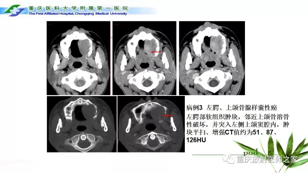 【PPT】颌骨常见肿瘤及肿瘤样病变的CT诊断及鉴别诊断-55