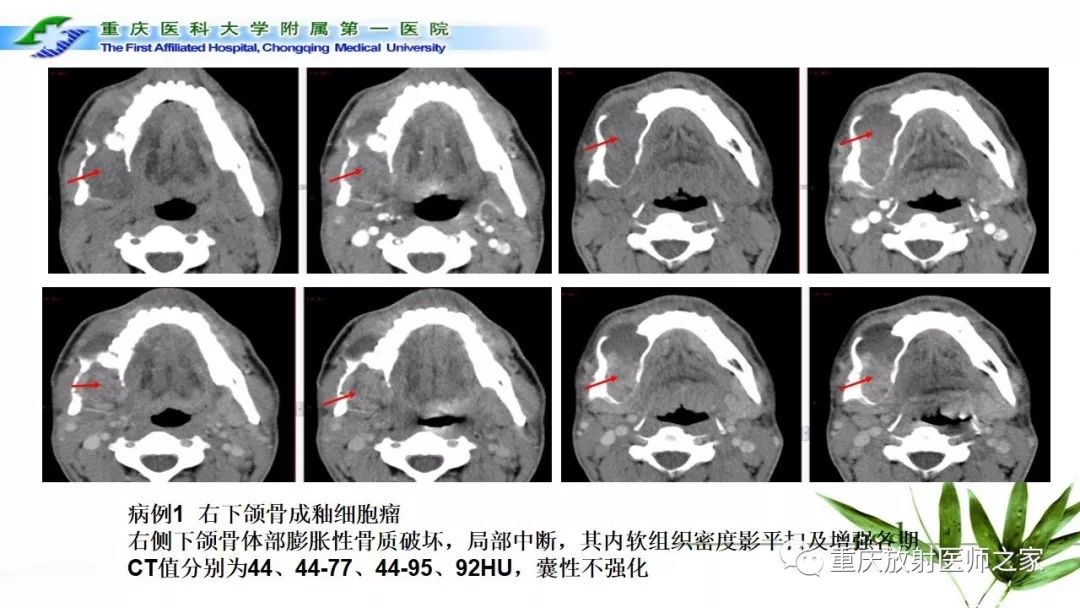 【PPT】颌骨常见肿瘤及肿瘤样病变的CT诊断及鉴别诊断-25