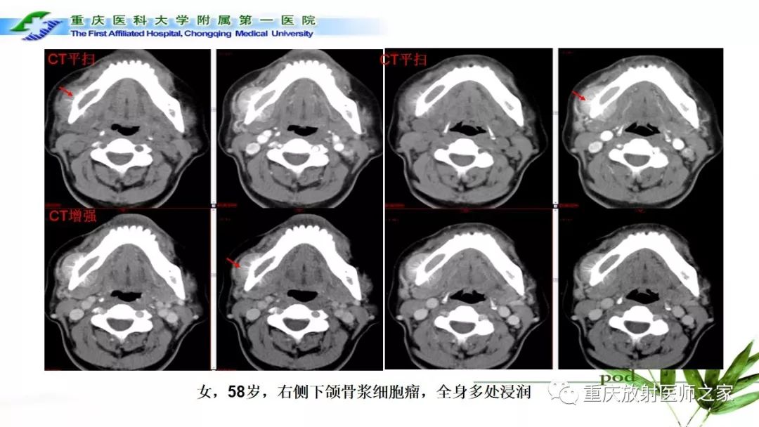 【PPT】颌骨常见肿瘤及肿瘤样病变的CT诊断及鉴别诊断-58