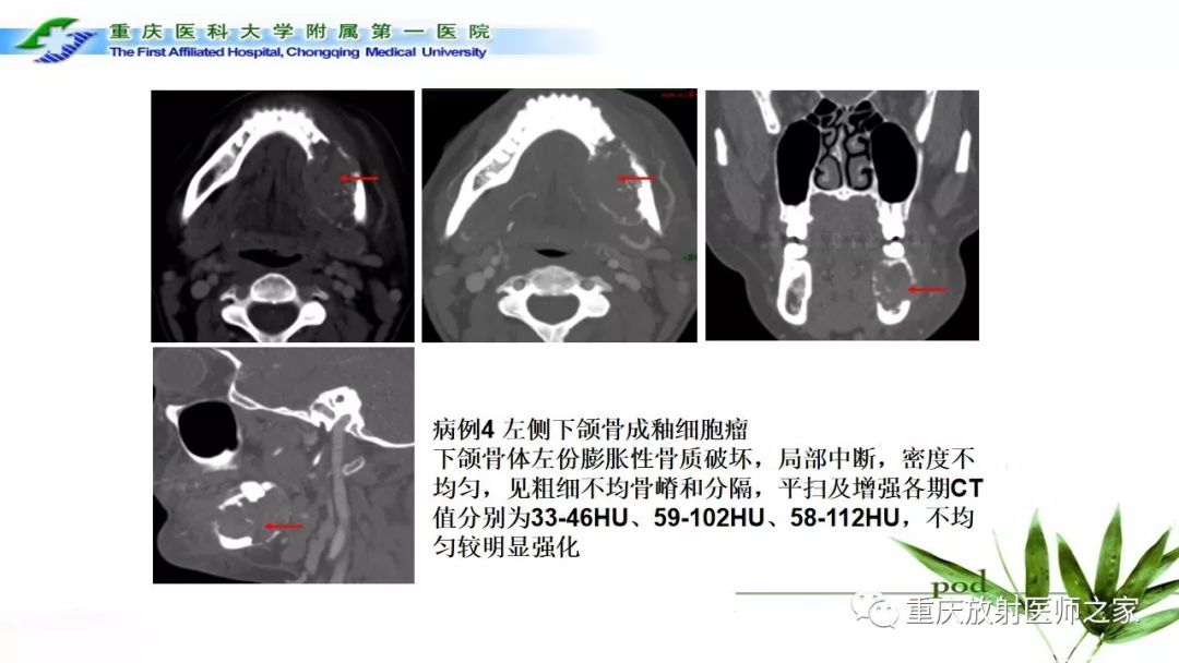 【PPT】颌骨常见肿瘤及肿瘤样病变的CT诊断及鉴别诊断-31