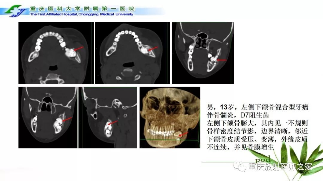 【PPT】颌骨常见肿瘤及肿瘤样病变的CT诊断及鉴别诊断-22