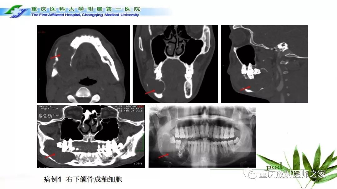 【PPT】颌骨常见肿瘤及肿瘤样病变的CT诊断及鉴别诊断-26