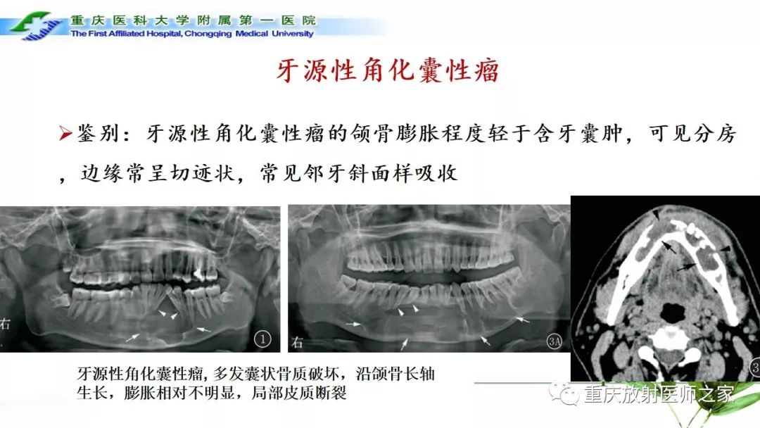 【PPT】颌骨常见肿瘤及肿瘤样病变的CT诊断及鉴别诊断-35