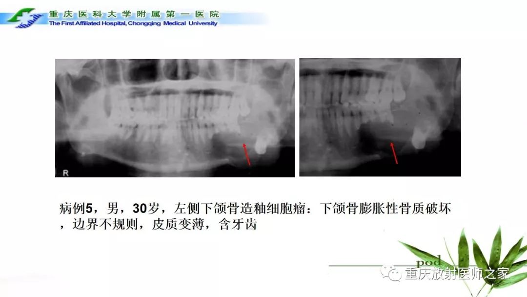 【PPT】颌骨常见肿瘤及肿瘤样病变的CT诊断及鉴别诊断-33