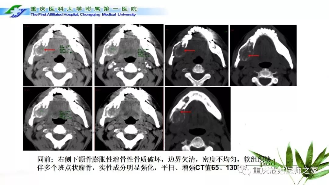 【PPT】颌骨常见肿瘤及肿瘤样病变的CT诊断及鉴别诊断-53