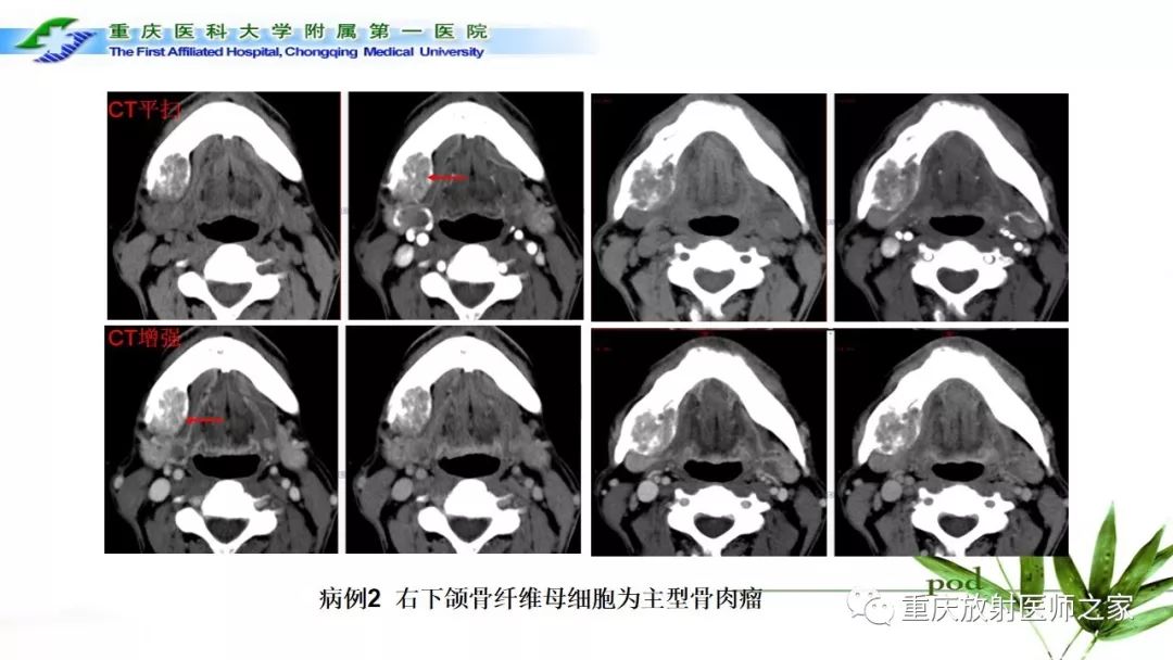 【PPT】颌骨常见肿瘤及肿瘤样病变的CT诊断及鉴别诊断-52