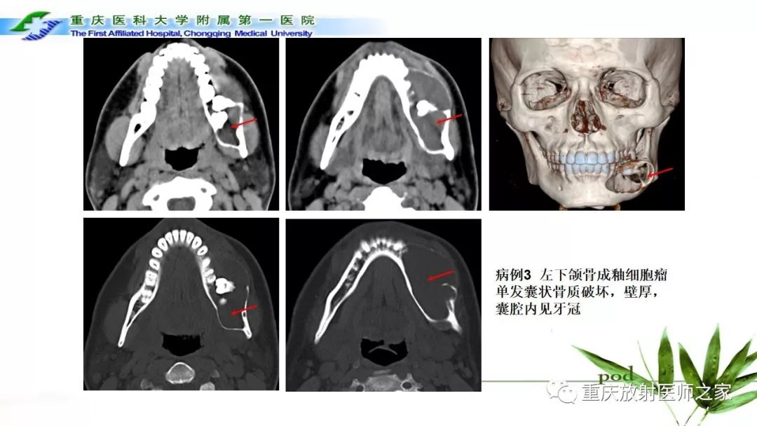 【PPT】颌骨常见肿瘤及肿瘤样病变的CT诊断及鉴别诊断-28