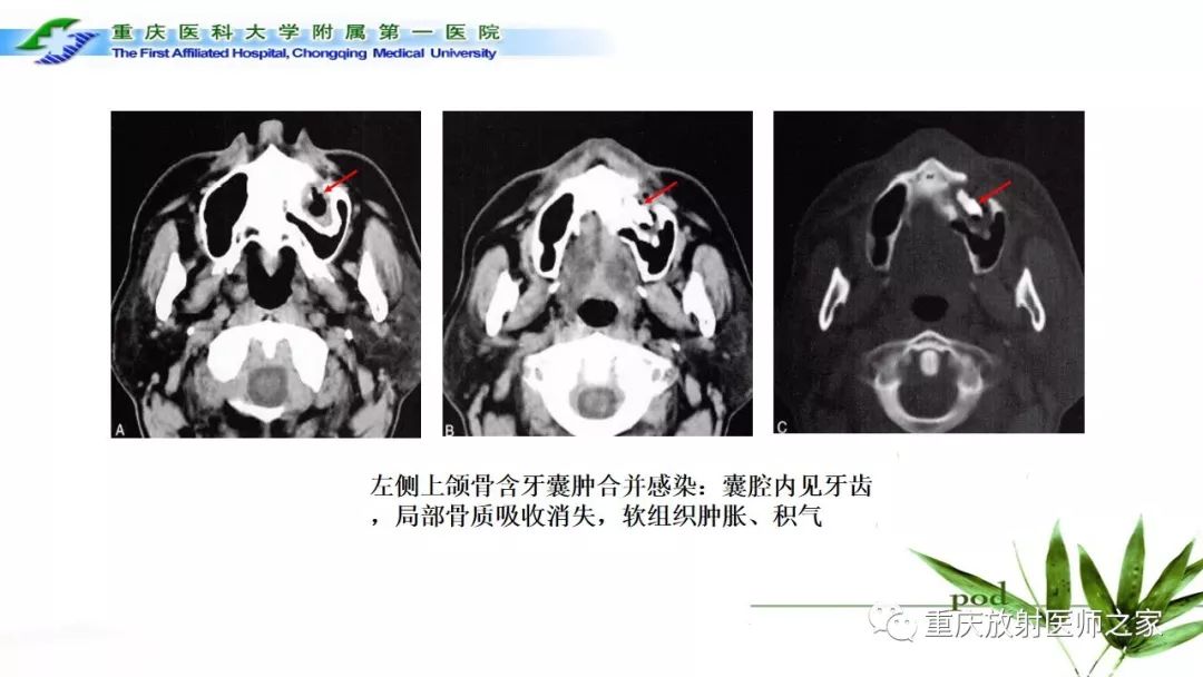 【PPT】颌骨常见肿瘤及肿瘤样病变的CT诊断及鉴别诊断-12