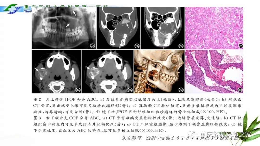 【PPT】颌骨常见肿瘤及肿瘤样病变的CT诊断及鉴别诊断-42