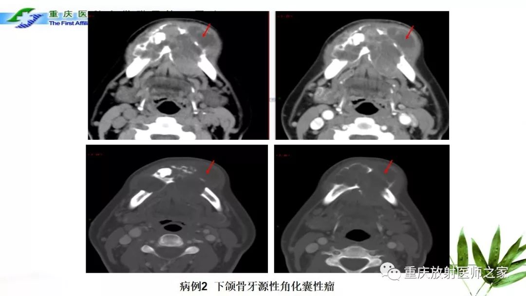 【PPT】颌骨常见肿瘤及肿瘤样病变的CT诊断及鉴别诊断-16