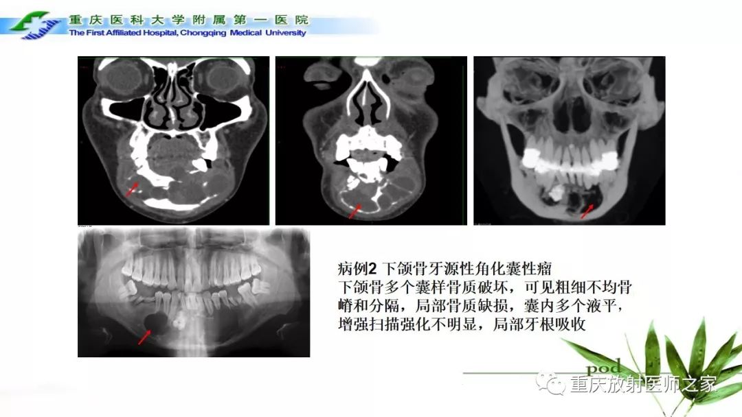 【PPT】颌骨常见肿瘤及肿瘤样病变的CT诊断及鉴别诊断-17