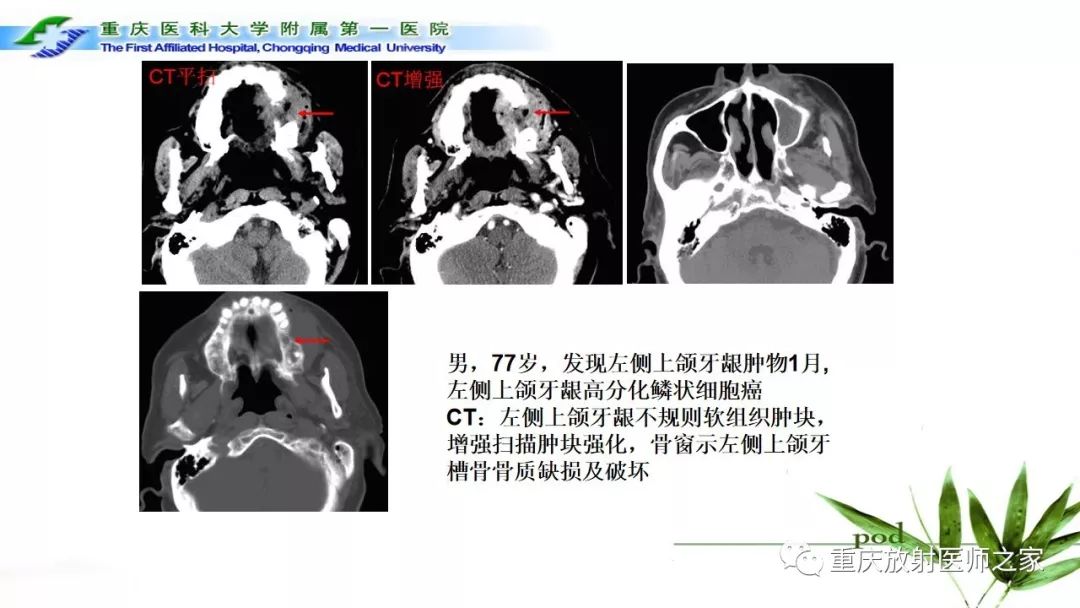 【PPT】颌骨常见肿瘤及肿瘤样病变的CT诊断及鉴别诊断-57