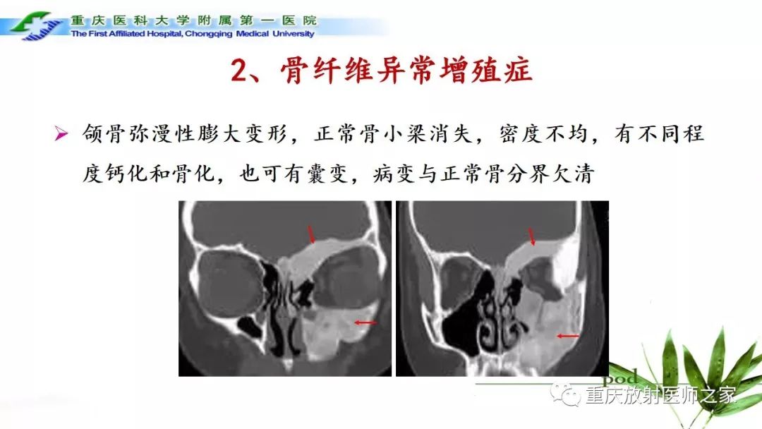 【PPT】颌骨常见肿瘤及肿瘤样病变的CT诊断及鉴别诊断-46