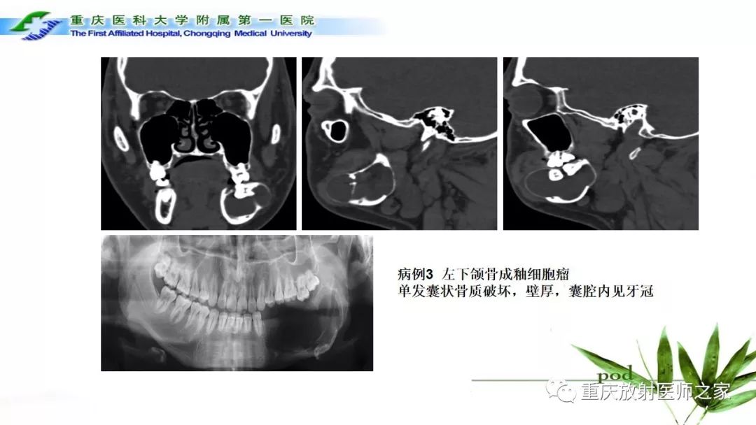 【PPT】颌骨常见肿瘤及肿瘤样病变的CT诊断及鉴别诊断-29