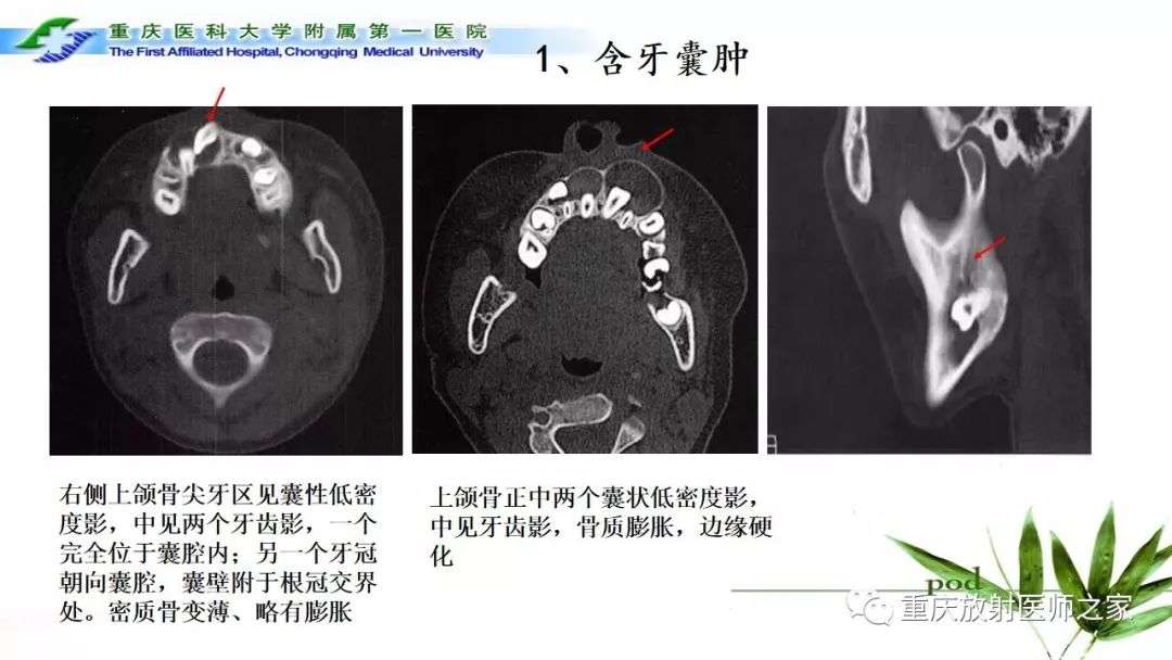 【PPT】颌骨常见肿瘤及肿瘤样病变的CT诊断及鉴别诊断-9