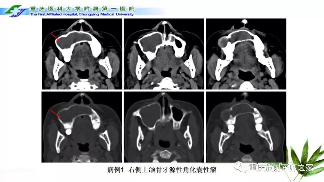 【PPT】颌骨常见肿瘤及肿瘤样病变的CT诊断及鉴别诊断-14