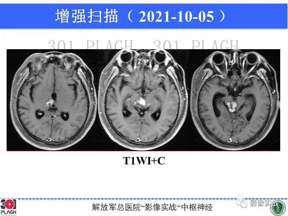 【病例】中枢神经系统生殖细胞肿瘤1例MR-16