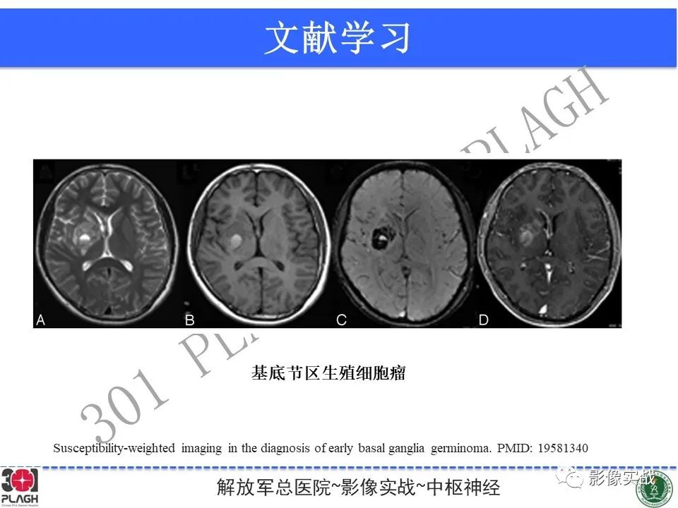 【病例】中枢神经系统生殖细胞肿瘤1例MR-37