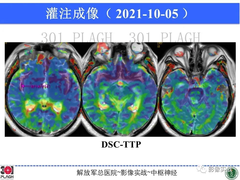 【病例】中枢神经系统生殖细胞肿瘤1例MR-22