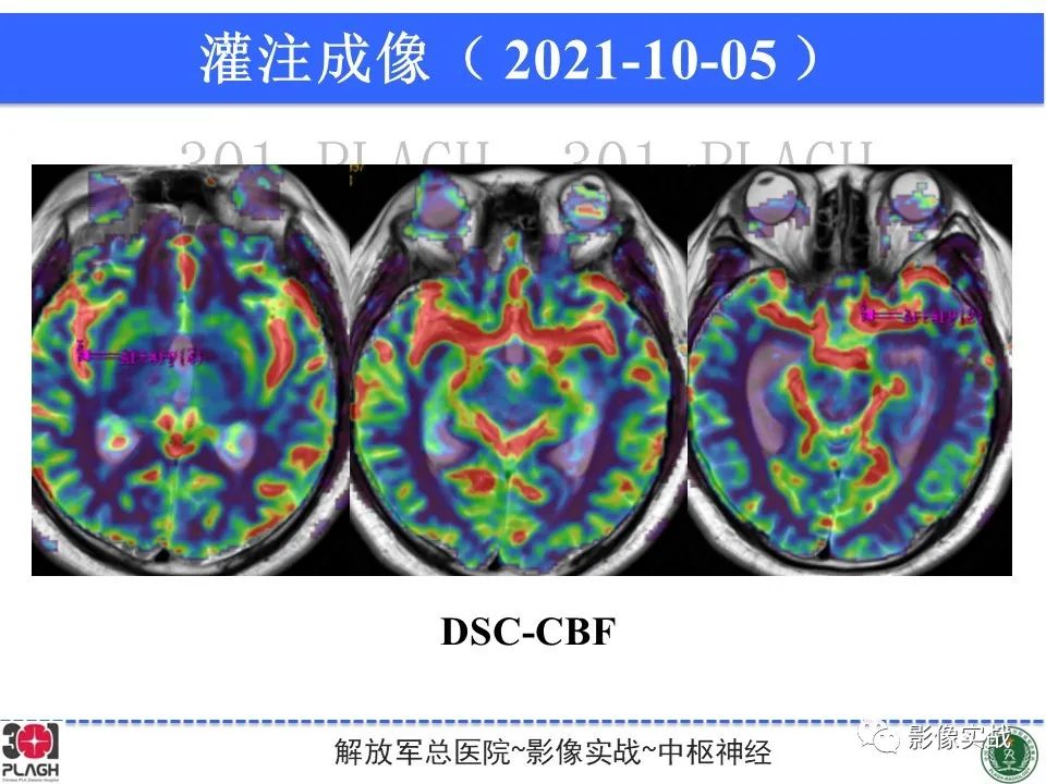 【病例】中枢神经系统生殖细胞肿瘤1例MR-21