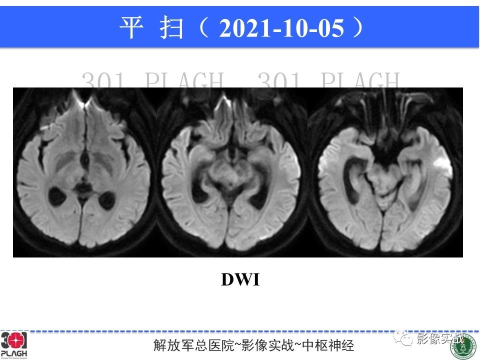 【病例】中枢神经系统生殖细胞肿瘤1例MR-12