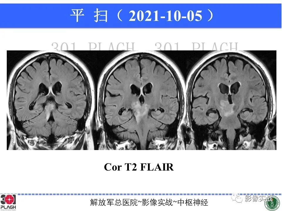 【病例】中枢神经系统生殖细胞肿瘤1例MR-14