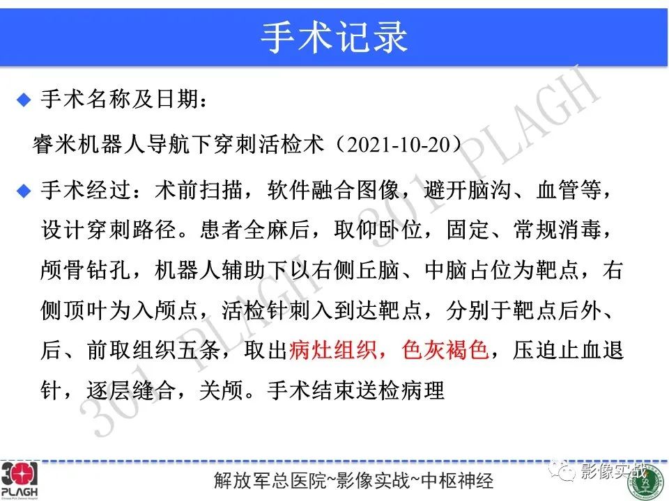 【病例】中枢神经系统生殖细胞肿瘤1例MR-32