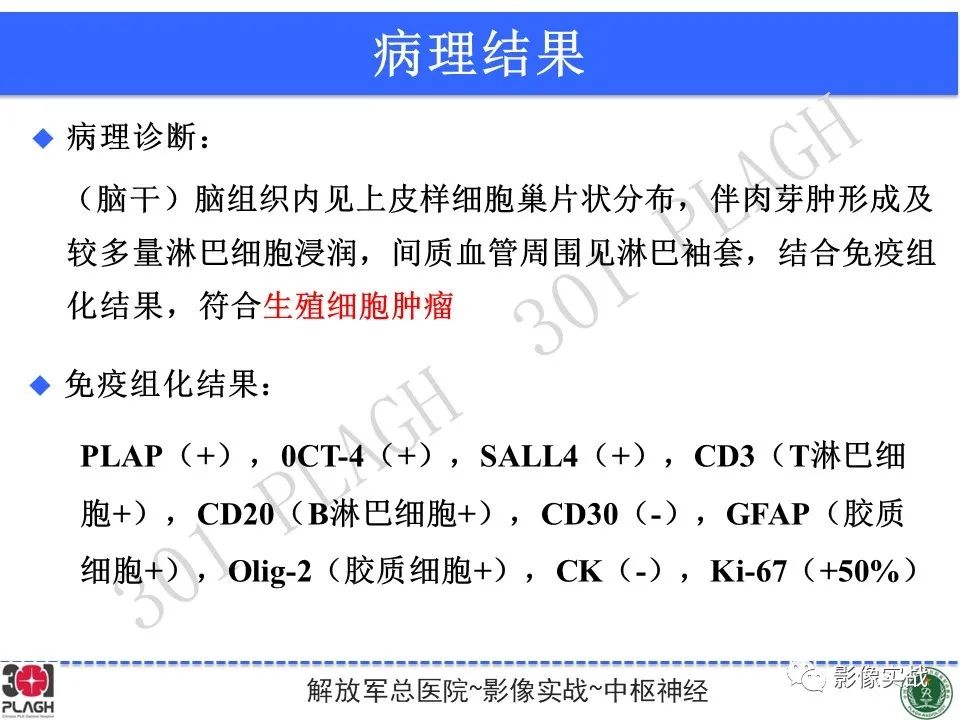 【病例】中枢神经系统生殖细胞肿瘤1例MR-33