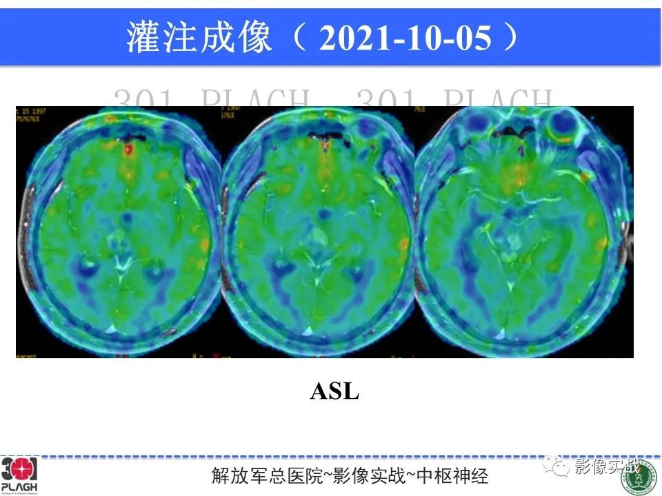 【病例】中枢神经系统生殖细胞肿瘤1例MR-19