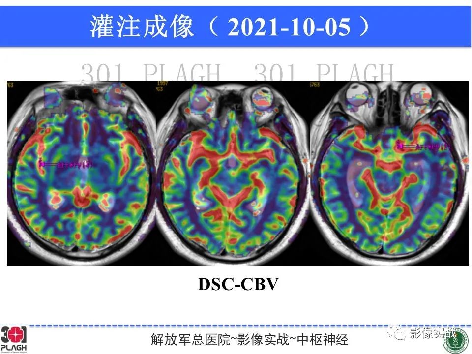 【病例】中枢神经系统生殖细胞肿瘤1例MR-20
