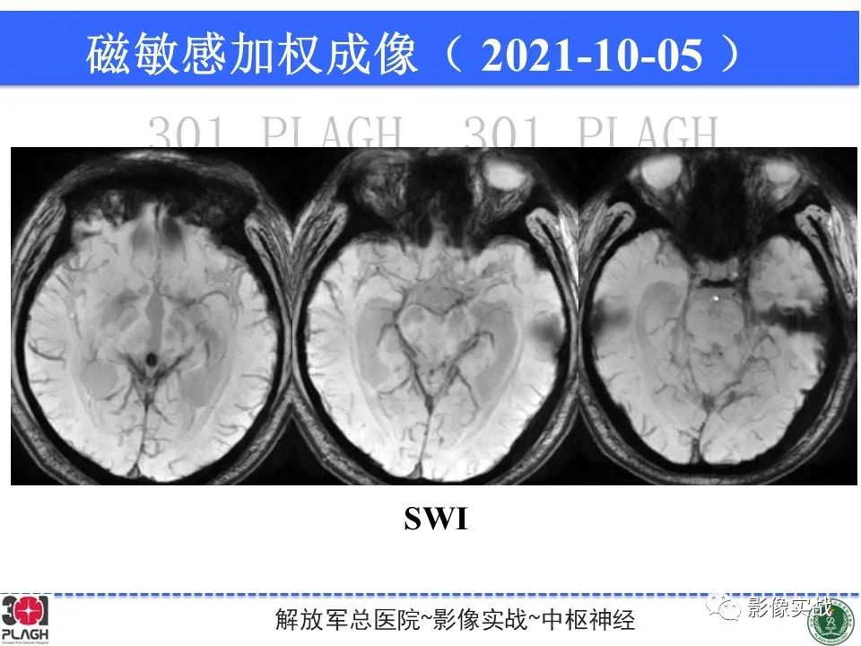 【病例】中枢神经系统生殖细胞肿瘤1例MR-24