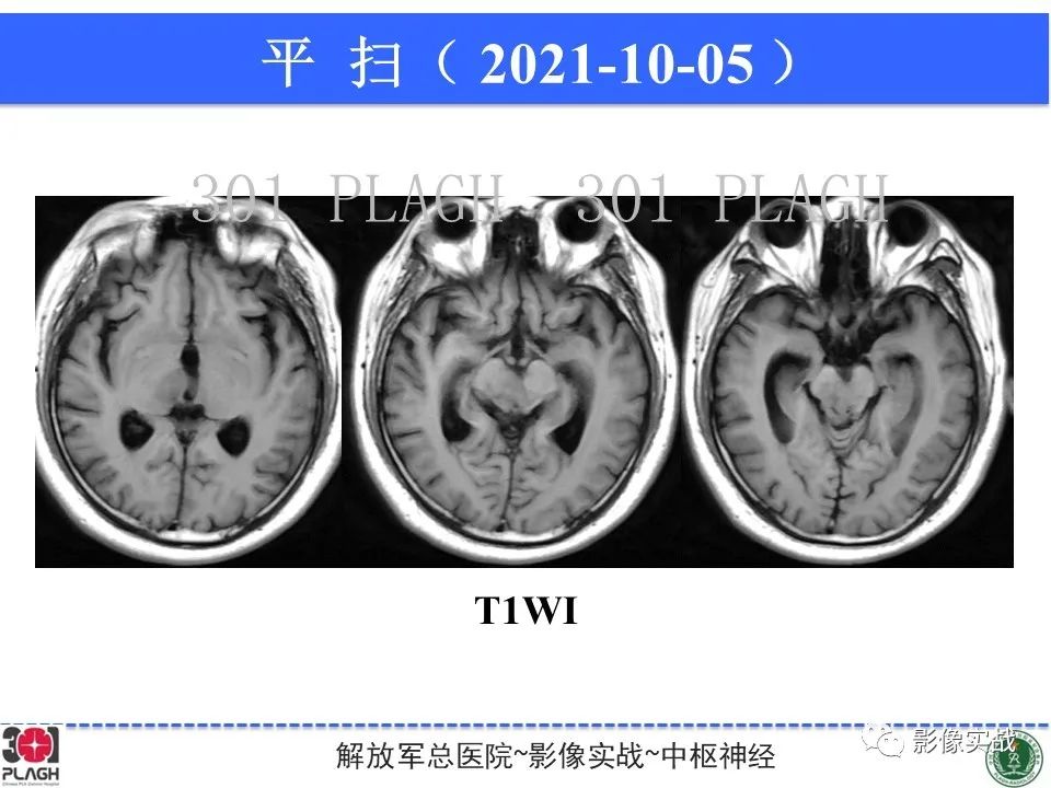【病例】中枢神经系统生殖细胞肿瘤1例MR-11