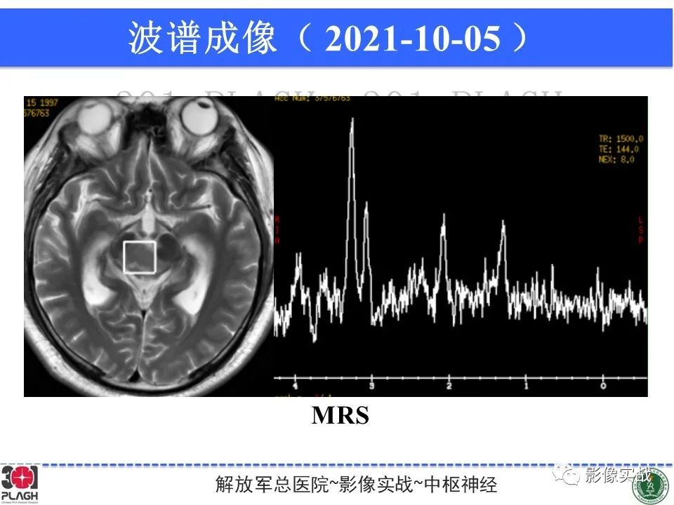 【病例】中枢神经系统生殖细胞肿瘤1例MR-25