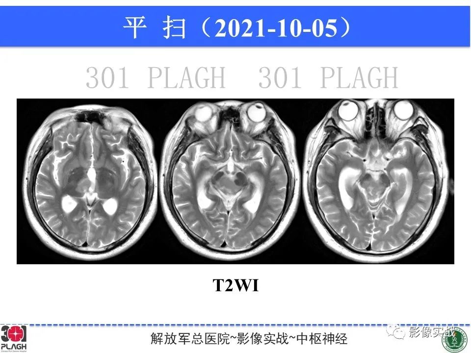 【病例】中枢神经系统生殖细胞肿瘤1例MR-10