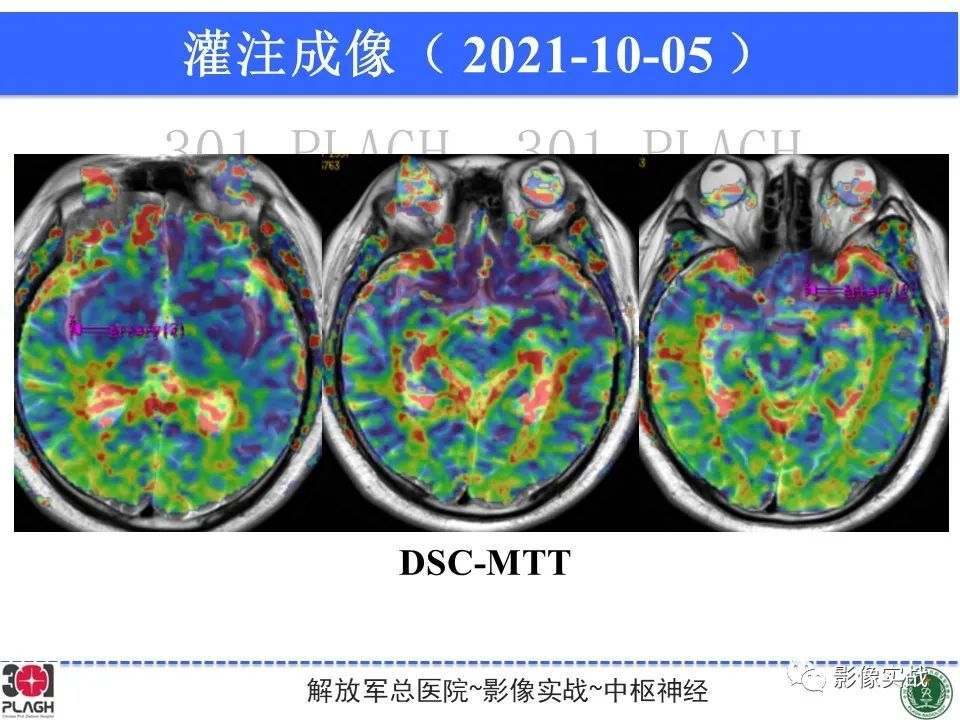 【病例】中枢神经系统生殖细胞肿瘤1例MR-23
