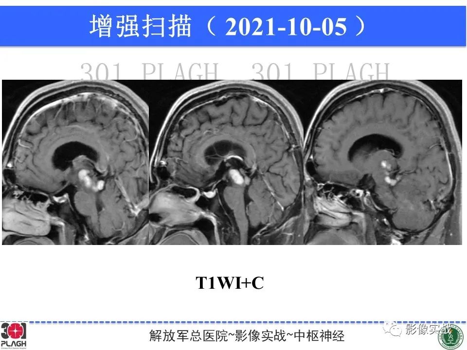 【病例】中枢神经系统生殖细胞肿瘤1例MR-18