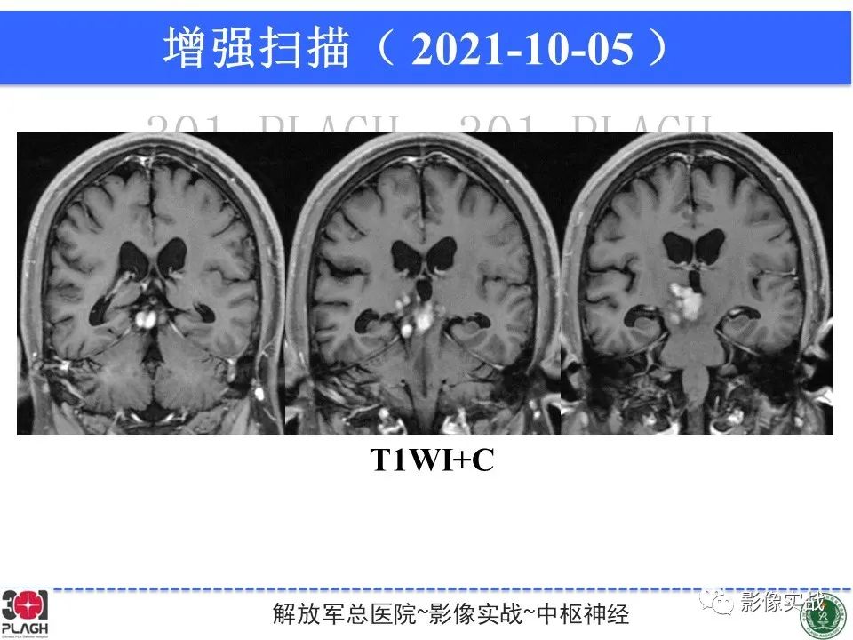 【病例】中枢神经系统生殖细胞肿瘤1例MR-17