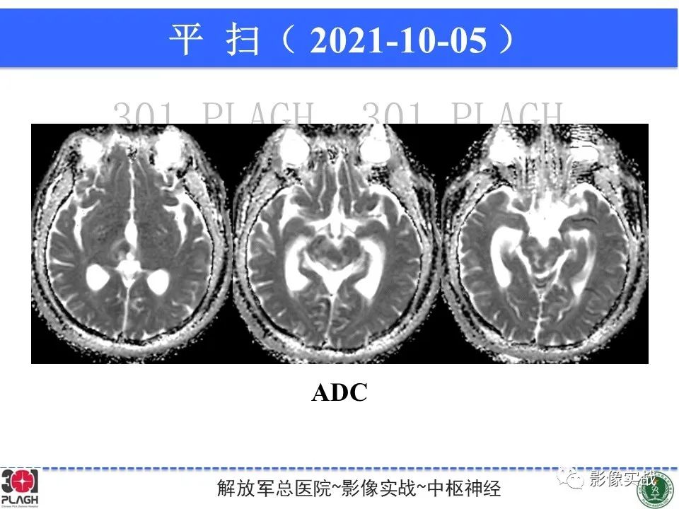 【病例】中枢神经系统生殖细胞肿瘤1例MR-13