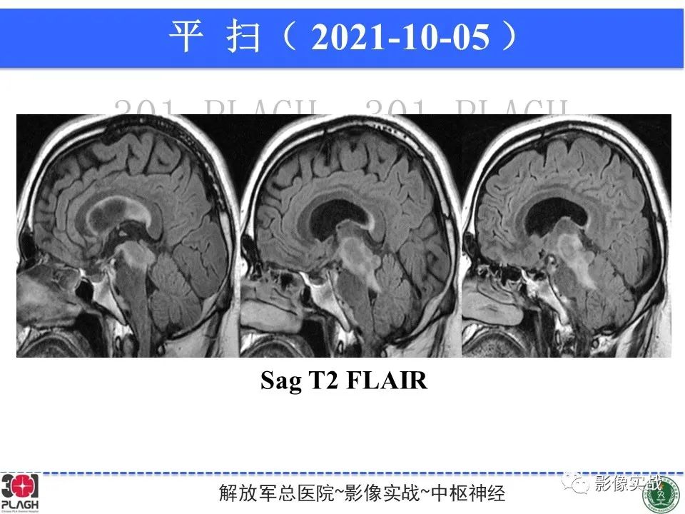 【病例】中枢神经系统生殖细胞肿瘤1例MR-15