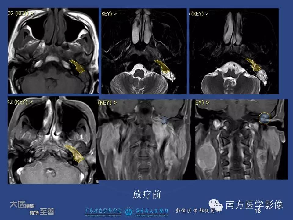 【PPT】鼻咽癌累及中耳及与中耳炎的鉴别-18
