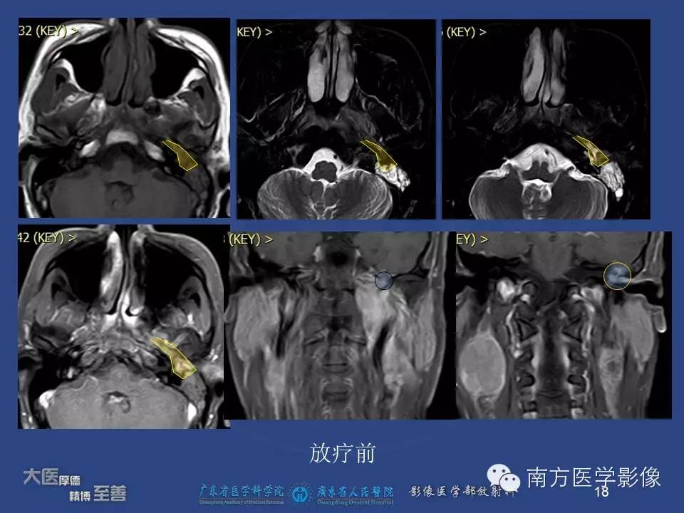 【PPT】鼻咽癌累及中耳及与中耳炎的鉴别-18